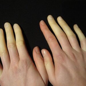 ¿Qué es el síndrome del dedo blanco?